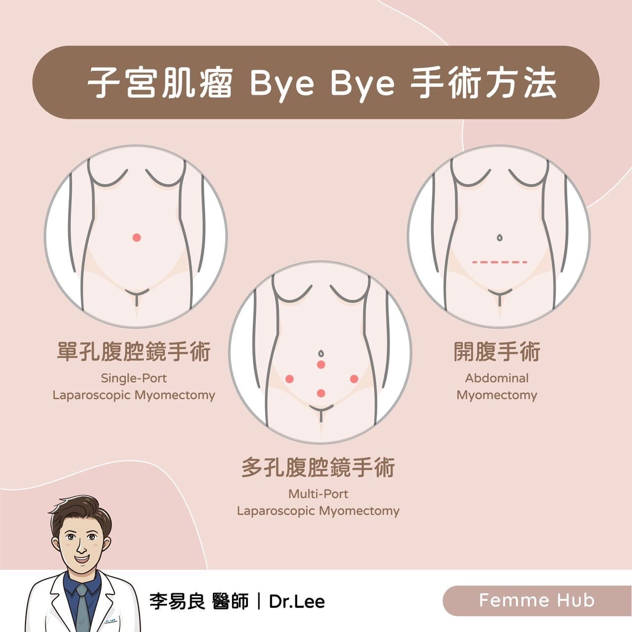 子宮肌瘤切除術 妳適合哪一種?