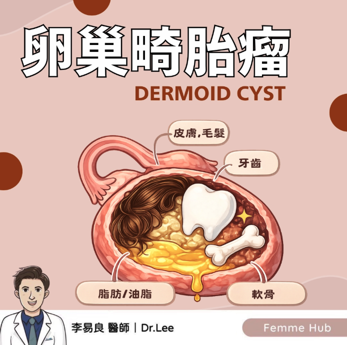 什麼是卵巢畸胎瘤?