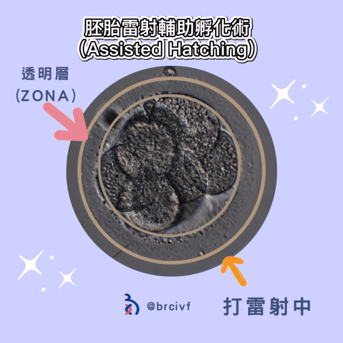 胚胎也要打雷射嗎?什麼是AHA( Assisted Hatching ,雷射輔助胚胎孵化 )