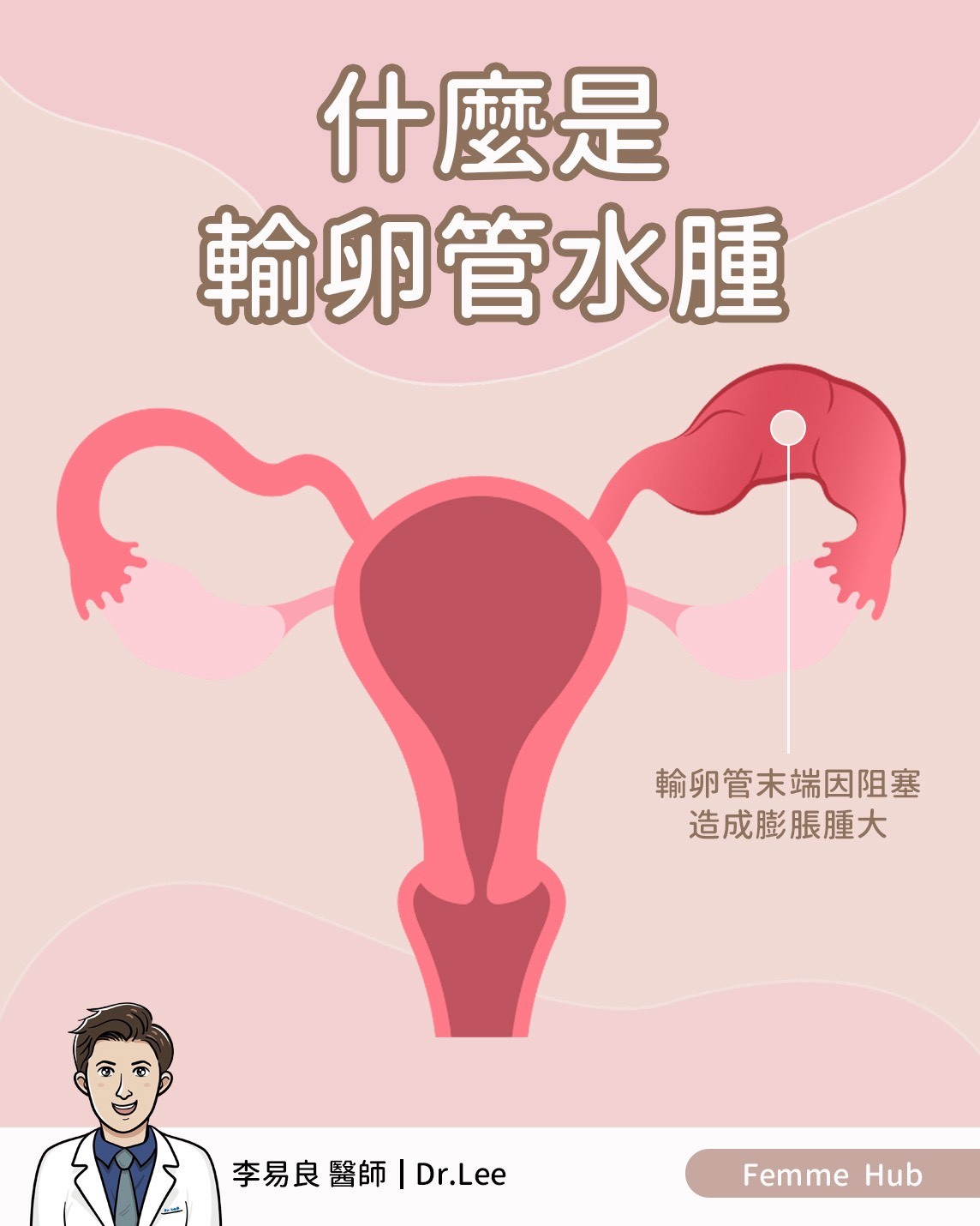 👨🏻⚕什麼是輸卵管水腫(Hydrosalpinx)? 『 上篇 』