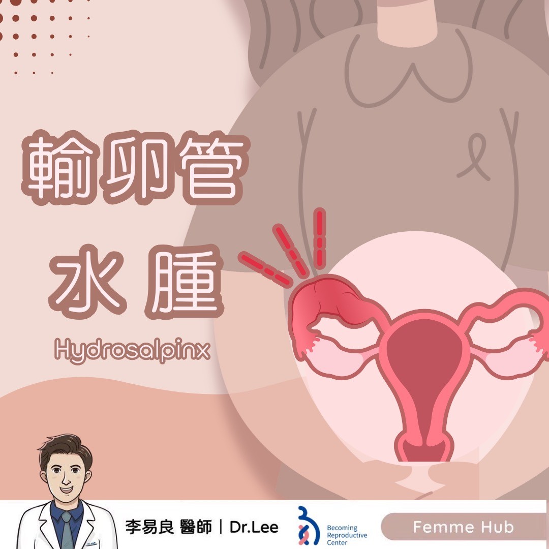 👨🏻⚕什麼是輸卵管水腫(Hydrosalpinx)? 『 下篇 』