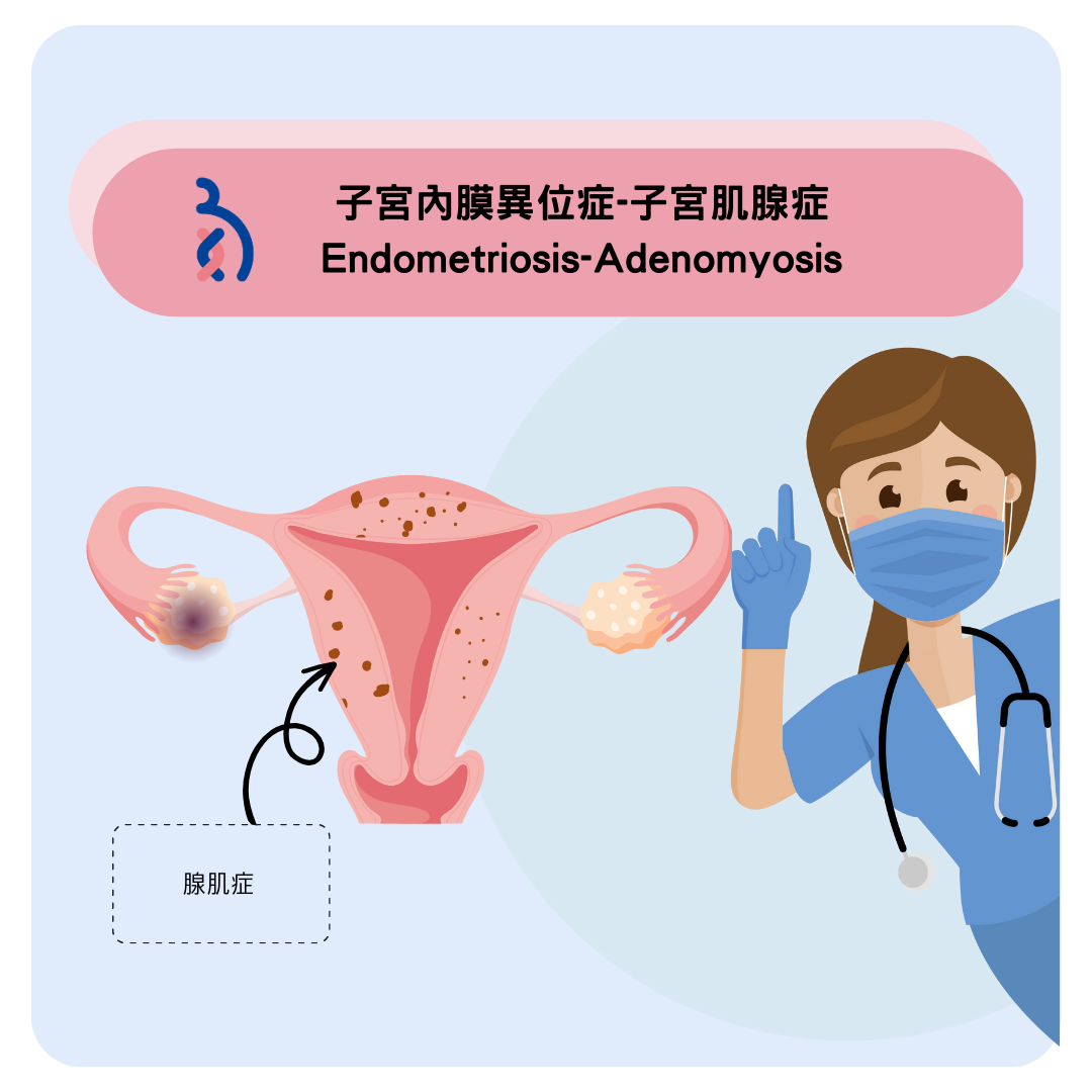 Understanding Adenomyoma