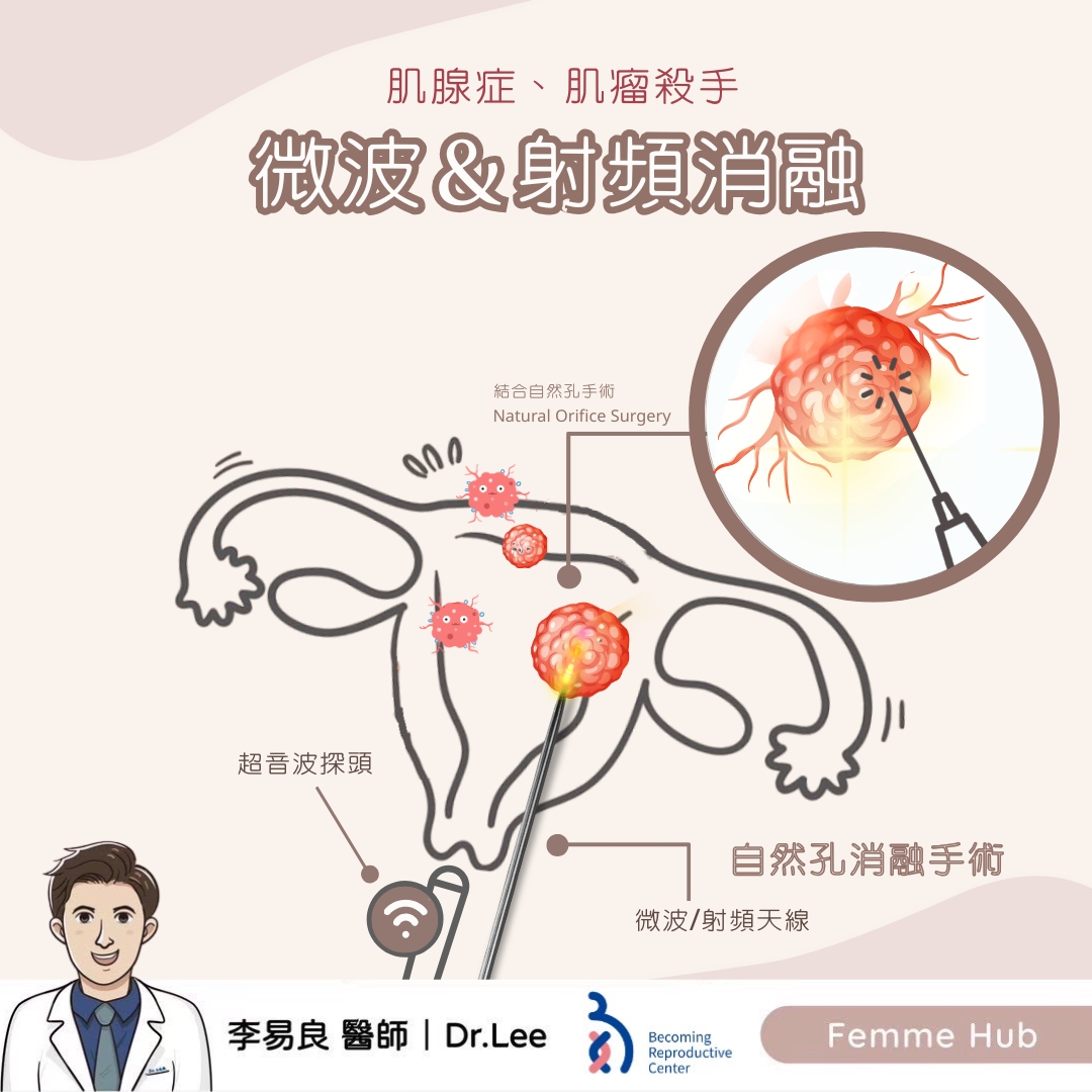 肌腺症及肌瘤殺手