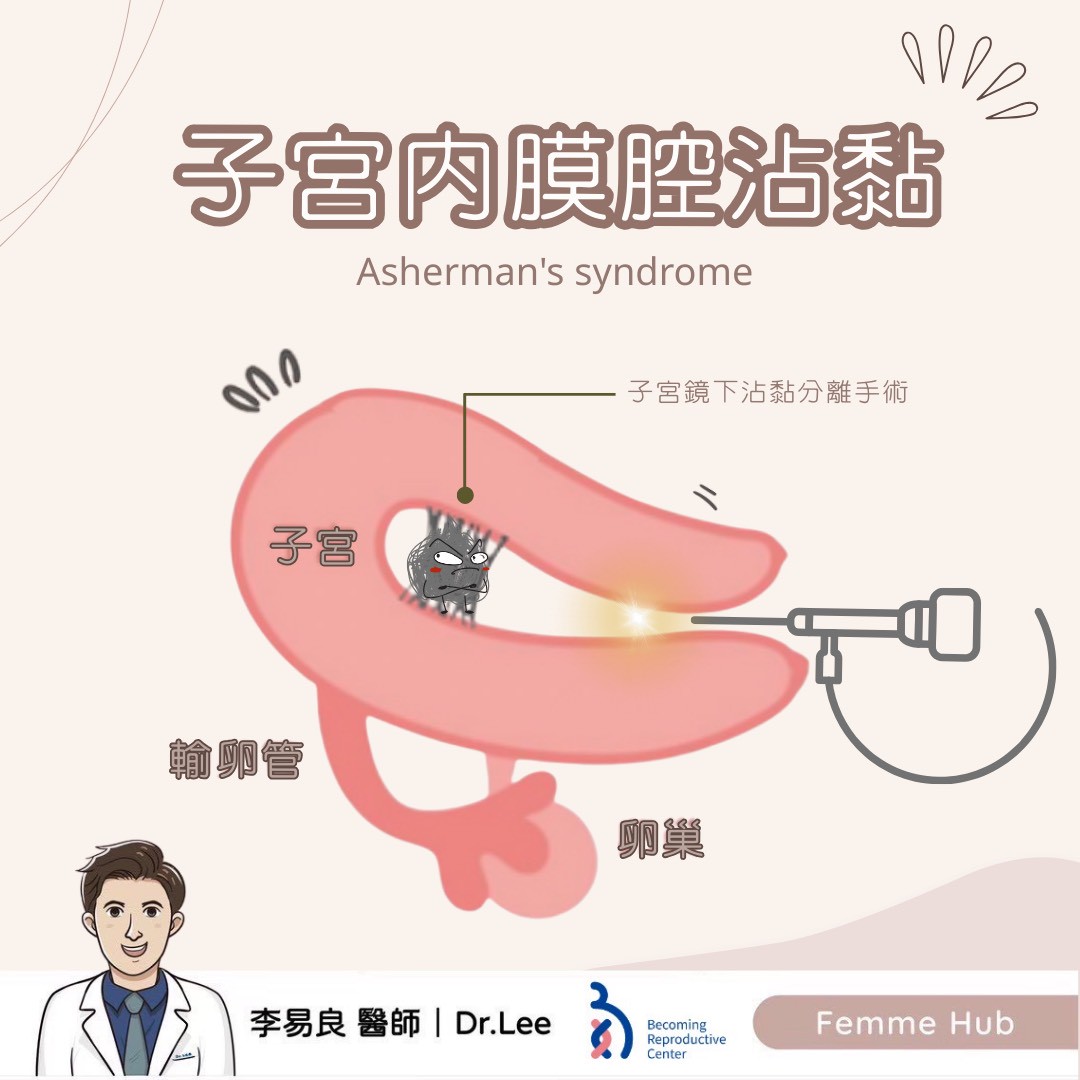 什麼是「子宮內膜腔沾黏」?