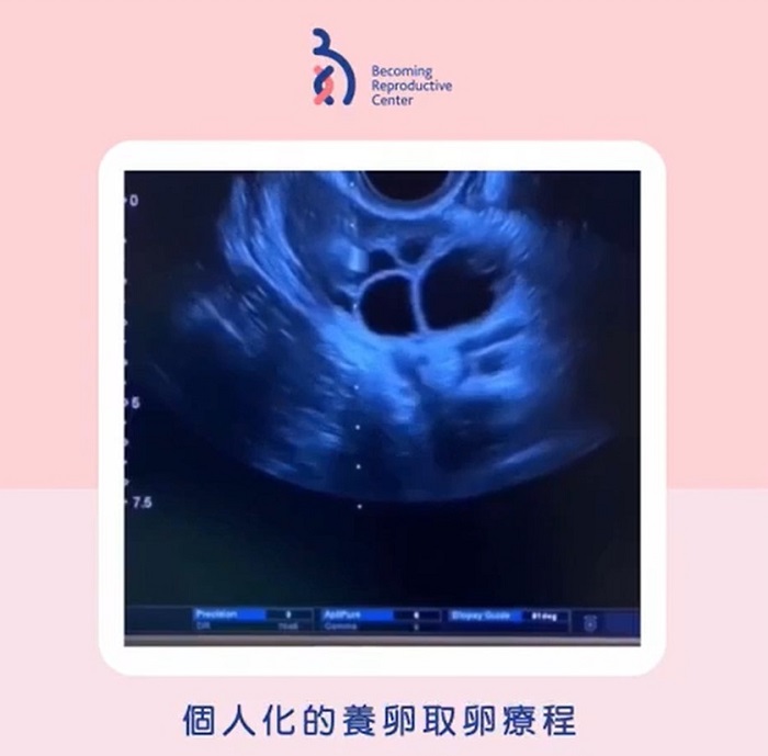 個人化的養卵取卵療程