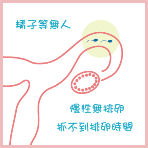多囊性卵巢症候群PCOS:Polycystic Ovaries Syndrome