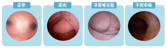 子宮內視鏡檢查
